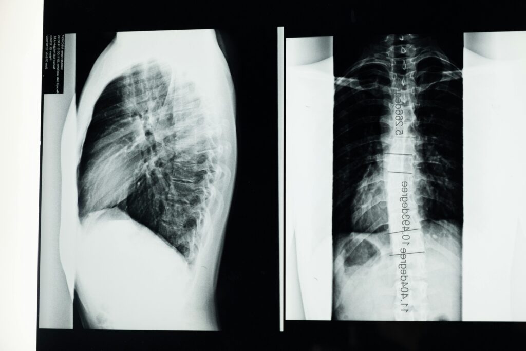 X-ray showing a detailed examination of human spine with scoliosis. Our scoliosis chiropractor can help!